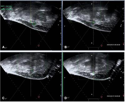 Exploring the Diagnostic Performance of Magnetic Resonance Imaging in Ultrasound-Guided High-Intensity Focused Ultrasound Ablation for Abdominal Wall Endometriosis